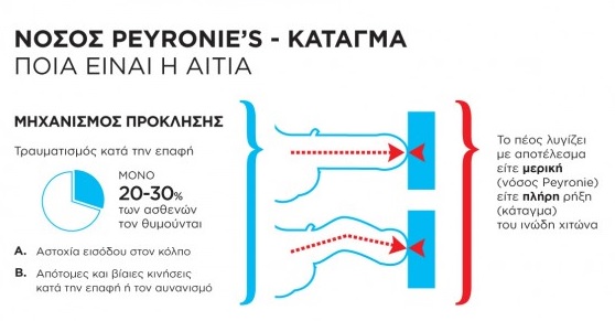 Κάταγμα πέους: Πώς συμβαίνει και τι πρέπει να κάνετε